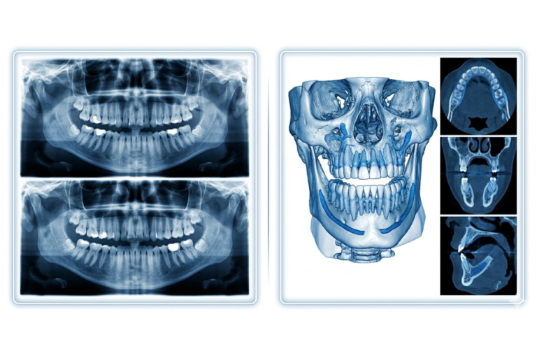 OPG vs CBCT — Which Dental X-ray Do You Actually Need?